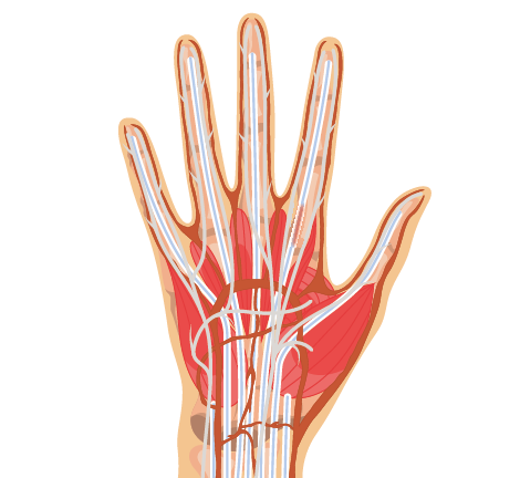Medical illustration of trigger finger, highlighting the mechanical impingement of the flexor tendon as it passes through the pulley, causing a sensation of locking or catching during finger movement